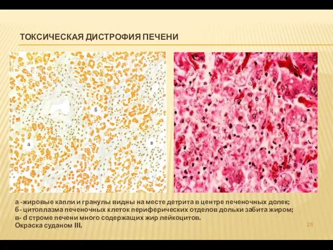 ТОКСИЧЕСКАЯ ДИСТРОФИЯ ПЕЧЕНИ а -жировые капли и гранулы видны на месте детрита