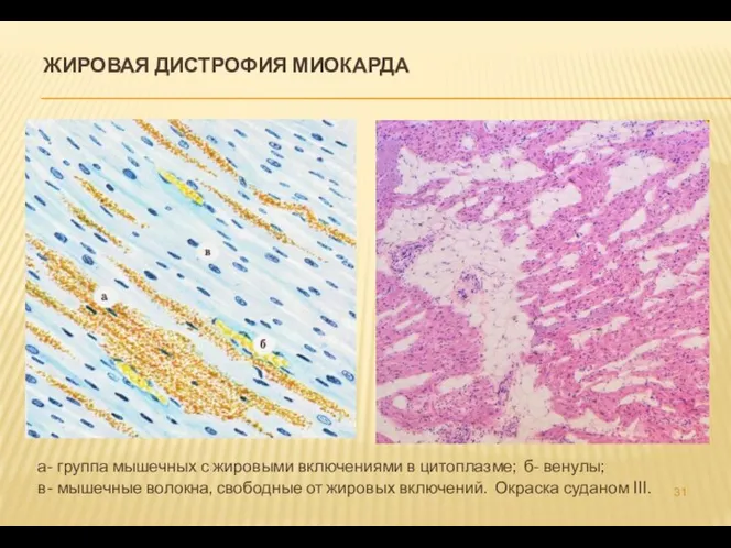 ЖИРОВАЯ ДИСТРОФИЯ МИОКАРДА а- группа мышечных с жировыми включениями в цитоплазме; б-