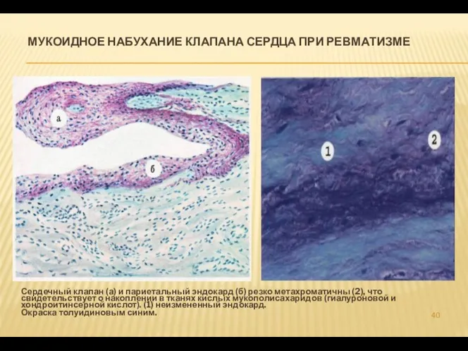 МУКОИДНОЕ НАБУХАНИЕ КЛАПАНА СЕРДЦА ПРИ РЕВМАТИЗМЕ Сердечный клапан (а) и париетальный эндокард