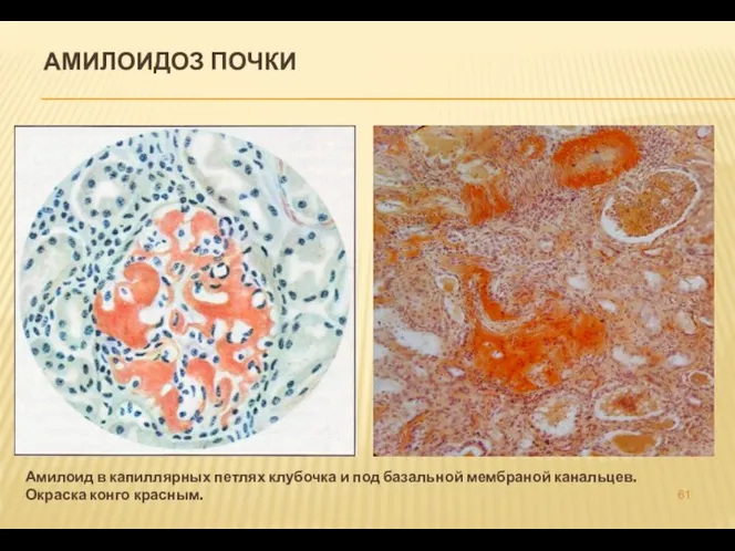 АМИЛОИДОЗ ПОЧКИ Амилоид в капиллярных петлях клубочка и под базальной мембраной канальцев. Окраска конго красным.