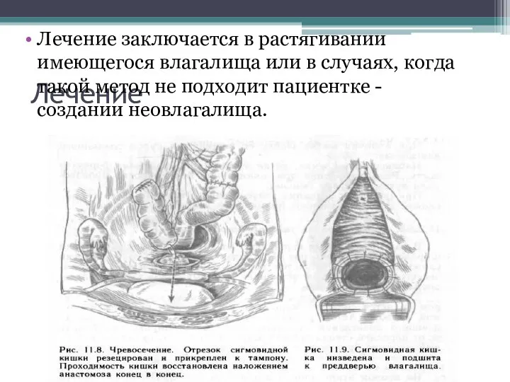 Лечение Лечение заключается в растягивании имеющегося влагалища или в случаях, когда такой