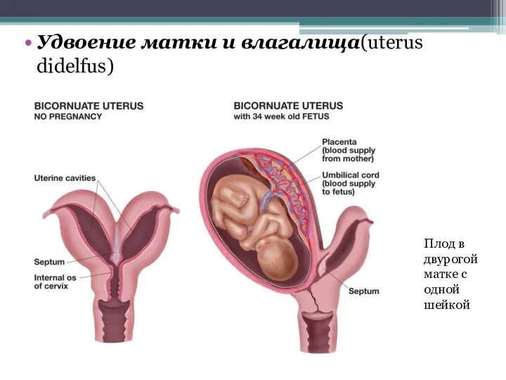 Удвоение матки и влагалища(uterus didelfus) Плод в двурогой матке с одной шейкой