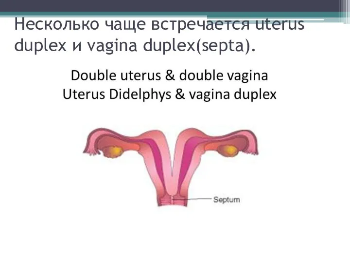 Несколько чаще встречается uterus duplex и vagina duplex(septa).