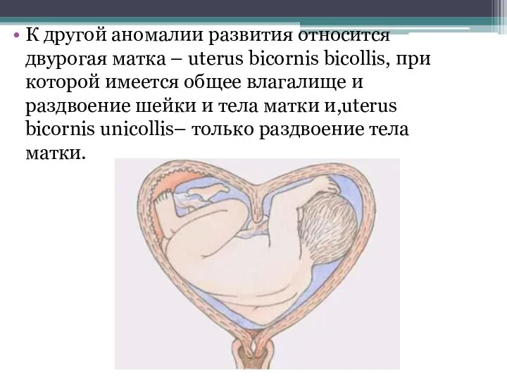 К другой аномалии развития относится двурогая матка – uterus bicornis bicollis, при