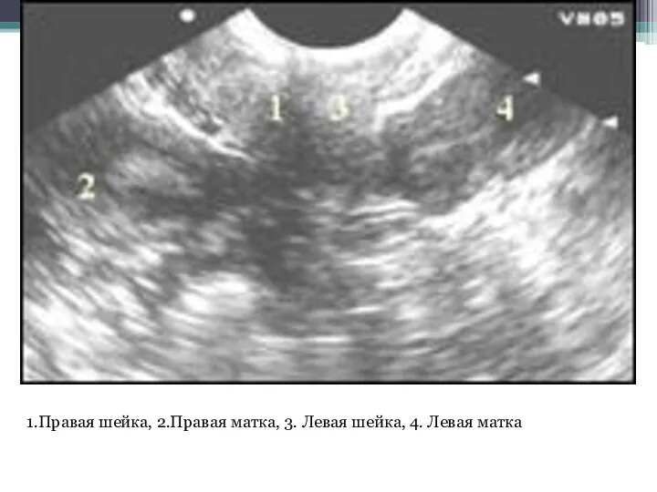 1.Правая шейка, 2.Правая матка, 3. Левая шейка, 4. Левая матка