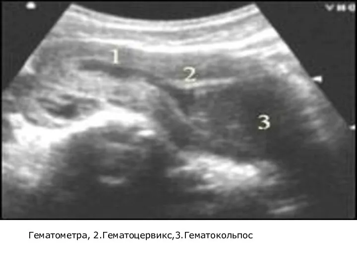 Гематометра, 2.Гематоцервикс,3.Гематокольпос