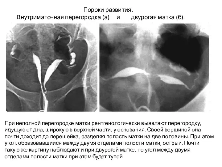 Пороки развития. Внутриматочная перегородка (а) и двурогая матка (б). При неполной перегородке