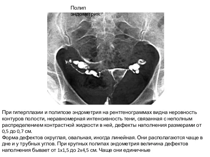 При гиперплазии и полипозе эндометрия на рентгенограммах видна неровность контуров полости, неравномерная