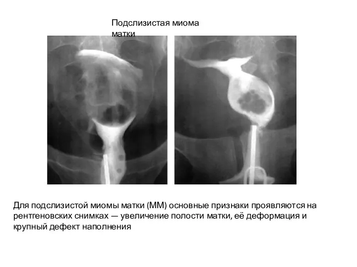 Для подслизистой миомы матки (ММ) основные признаки проявляются на рентгеновских снимках —