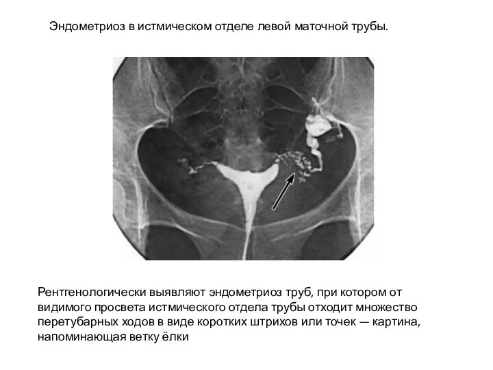 Эндометриоз в истмическом отделе левой маточной трубы. Рентгенологически выявляют эндометриоз труб, при