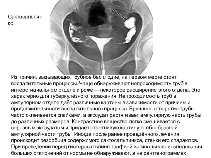 Из причин, вызывающих трубное бесплодие, на первом месте стоят воспалительные процессы. Чаще