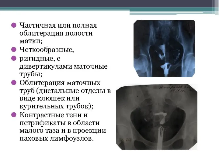 Частичная или полная облитерация полости матки; Четкообразные, ригидные, с дивертикулами маточные трубы;