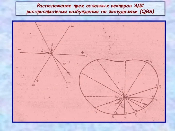 Расположение трех основных векторов ЭДС распространения возбуждения по желудочкам (QRS)