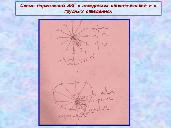Схема нормальной ЭКГ в отведениях от конечностей и в грудных отведениях