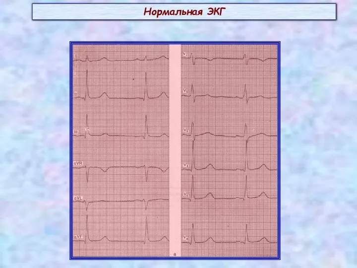 Нормальная ЭКГ