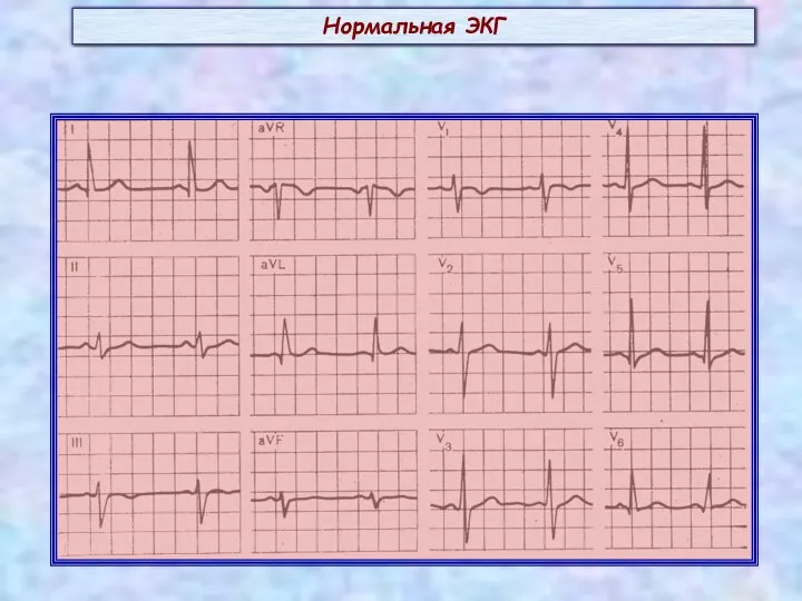 Нормальная ЭКГ