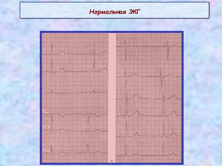 Нормальная ЭКГ