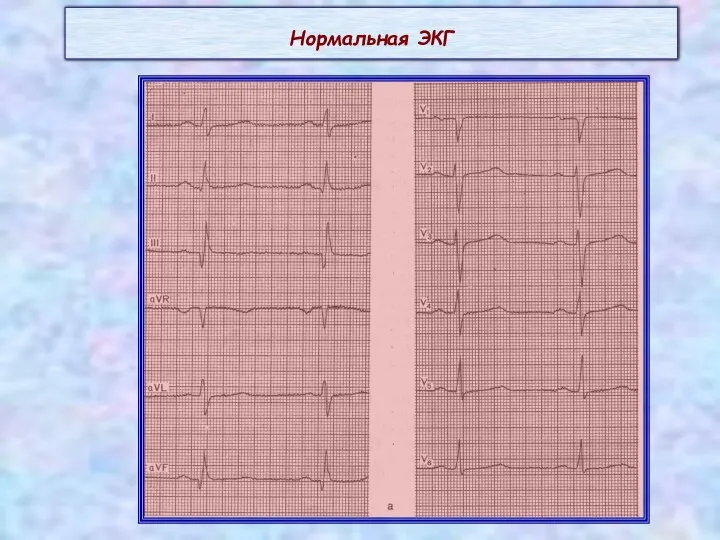 Нормальная ЭКГ