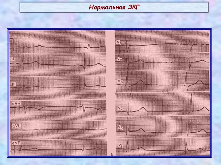 Нормальная ЭКГ
