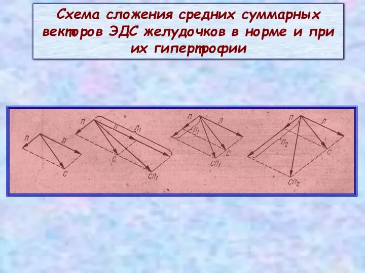 Схема сложения средних суммарных векторов ЭДС желудочков в норме и при их гипертрофии