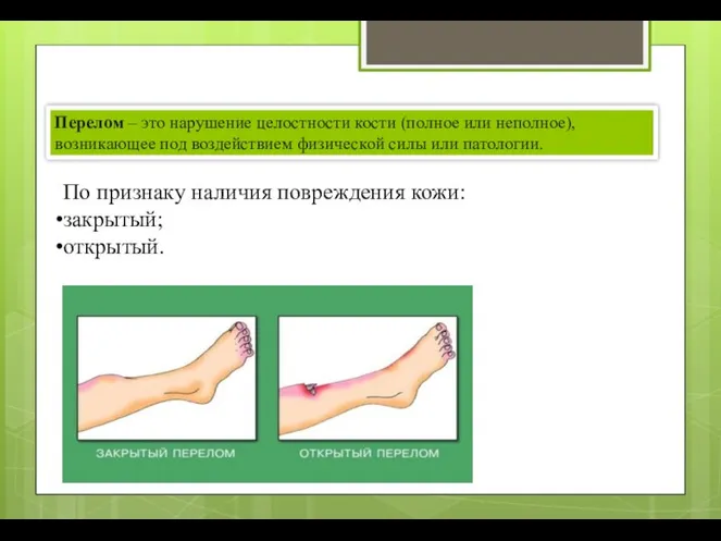 Перелом – это нарушение целостности кости (полное или неполное), возникающее под воздействием