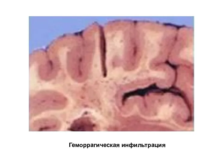 Геморрагическая инфильтрация