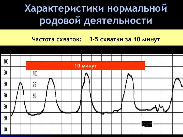 Характеристики нормальной родовой деятельности Частота схваток: 3-5 схватки за 10 минут 10 минут