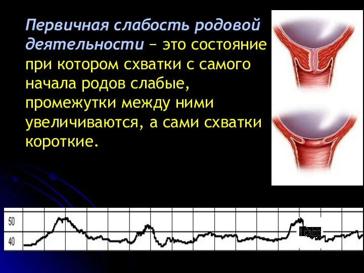 Первичная слабость родовой деятельности − это состояние при котором схватки с самого