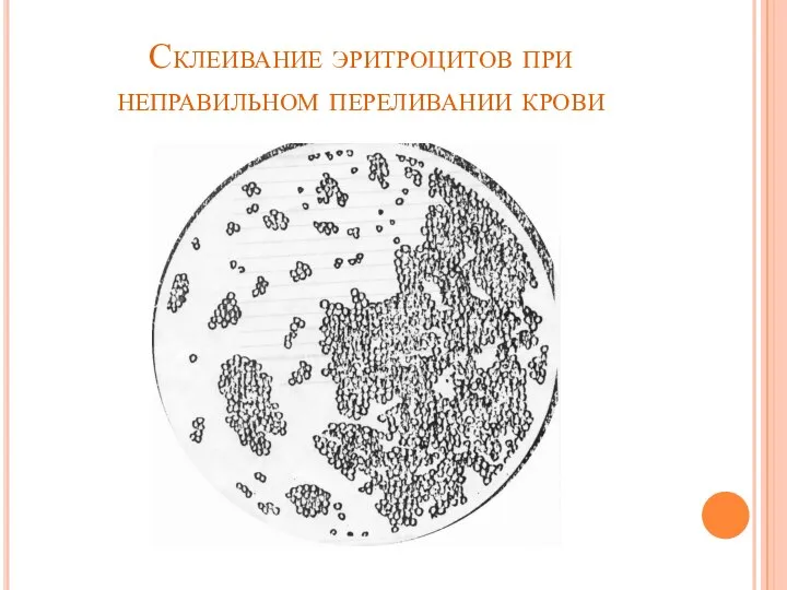 Склеивание эритроцитов при неправильном переливании крови