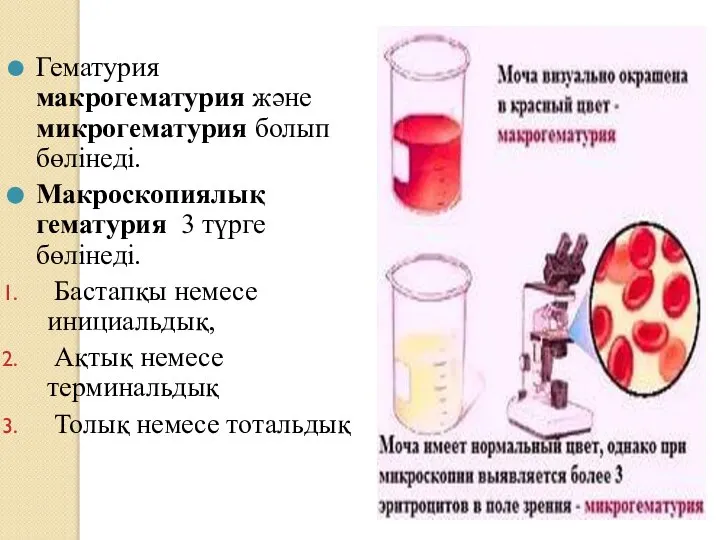 Гематурия макрогематурия және микрогематурия болып бөлінеді. Макроскопиялық гематурия 3 түрге бөлінеді. Бастапқы