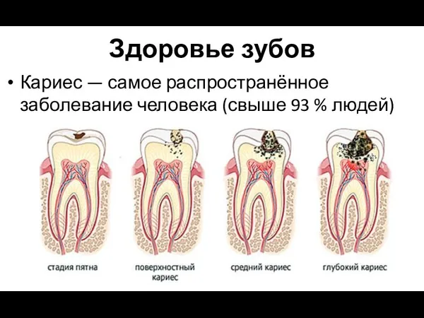 Здоровье зубов Кариес — самое распространённое заболевание человека (свыше 93 % людей)