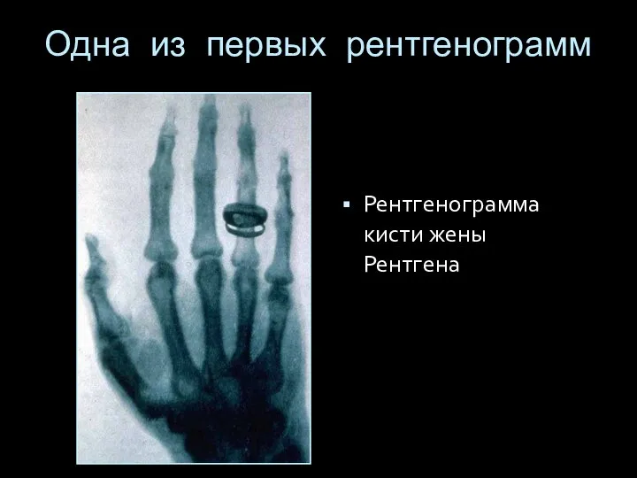 Одна из первых рентгенограмм Рентгенограмма кисти жены Рентгена