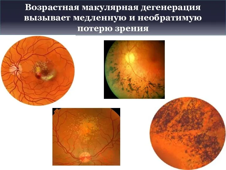 Возрастная макулярная дегенерация вызывает медленную и необратимую потерю зрения