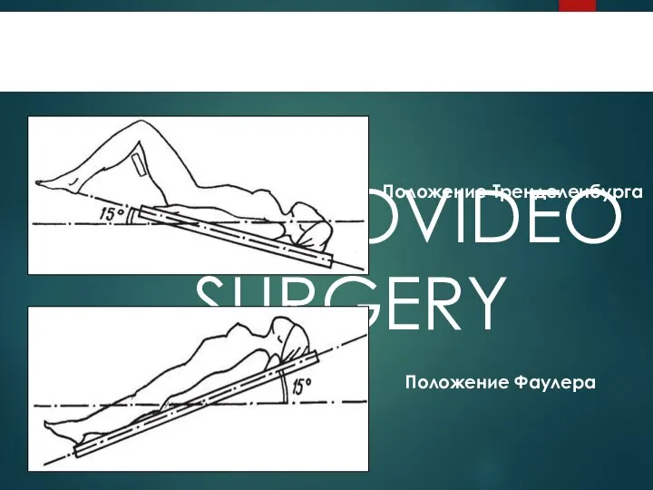 ENDOVIDEOSURGERY ПОЛОЖЕНИЕ ПАЦИЕНТА Положение Тренделенбурга Положение Фаулера