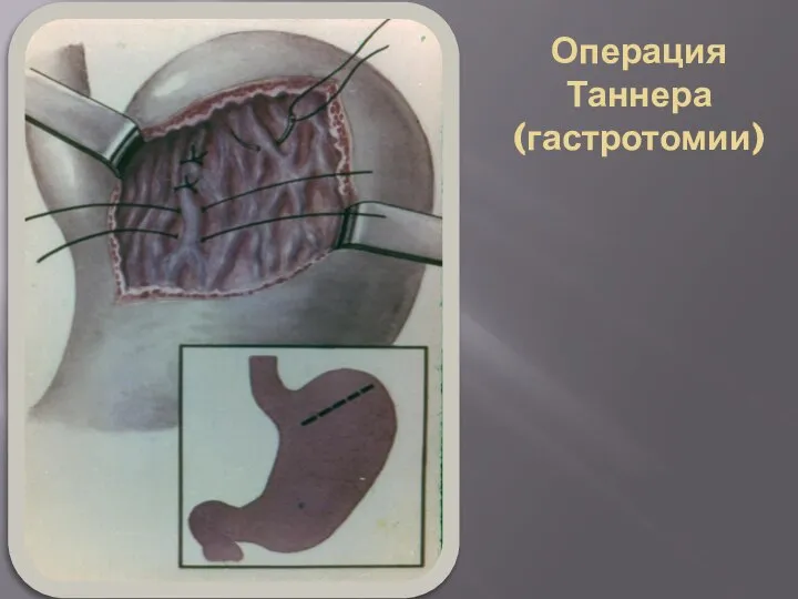 Операция Таннера (гастротомии)