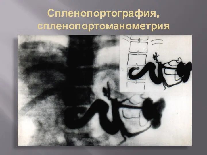 Спленопортография, спленопортоманометрия