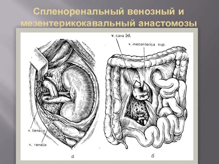 Спленоренальный венозный и мезентерикокавальный анастомозы