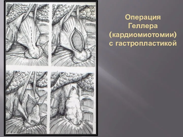 Операция Геллера (кардиомиотомии) с гастропластикой