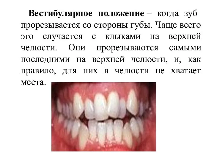 Вестибулярное положение – когда зуб прорезывается со стороны губы. Чаще всего это