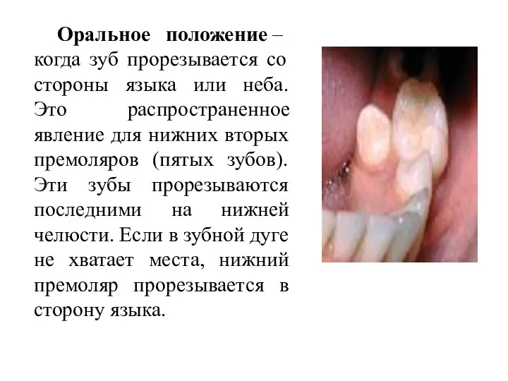 Оральное положение – когда зуб прорезывается со стороны языка или неба. Это
