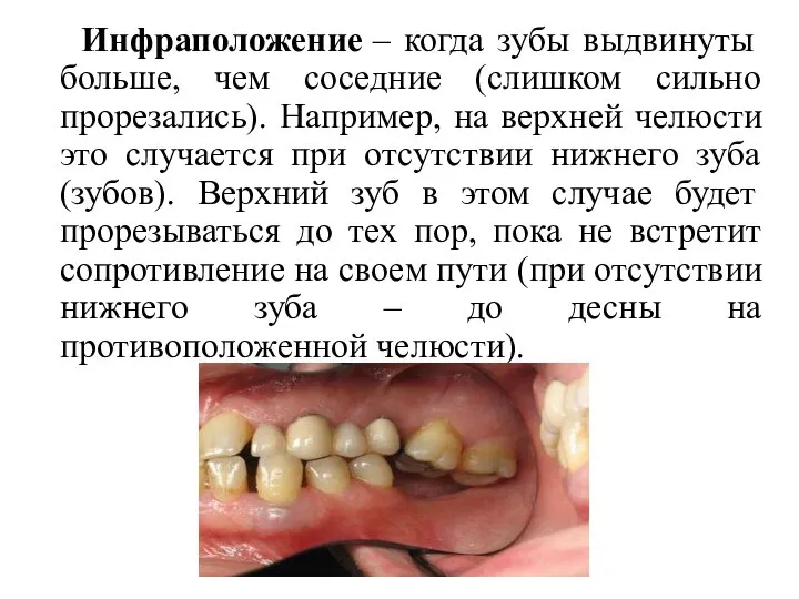 Инфраположение – когда зубы выдвинуты больше, чем соседние (слишком сильно прорезались). Например,