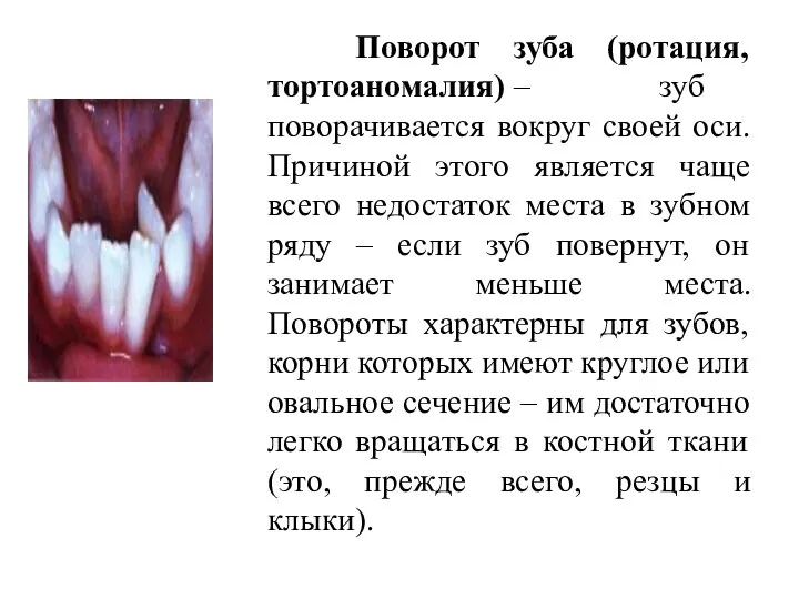 Поворот зуба (ротация, тортоаномалия) – зуб поворачивается вокруг своей оси. Причиной этого