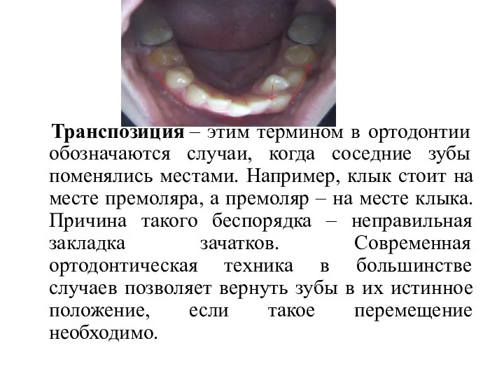 Транспозиция – этим термином в ортодонтии обозначаются случаи, когда соседние зубы поменялись