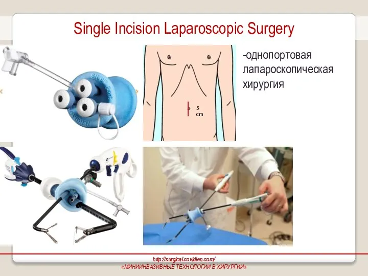 Single Incision Laparoscopic Surgery -однопортовая лапароскопическая хирургия http://surgical.covidien.com/ «МИНИИНВАЗИВНЫЕ ТЕХНОЛОГИИ В ХИРУРГИИ»