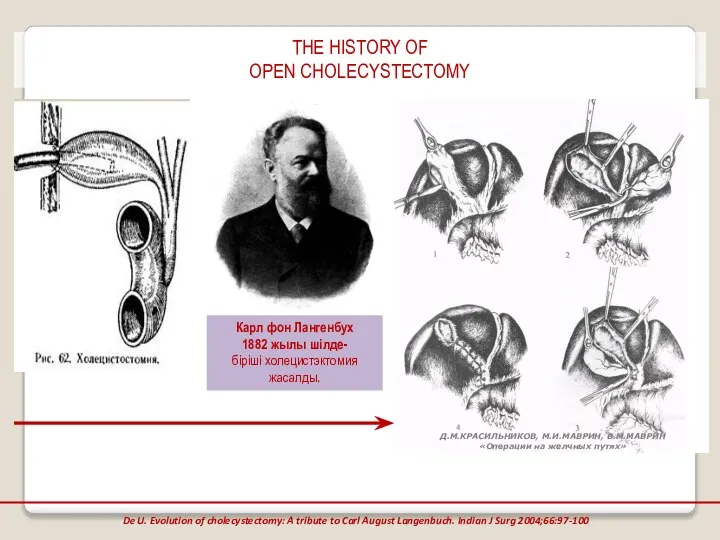 THE HISTORY OF OPEN CHOLECYSTECTOMY De U. Evolution of cholecystectomy: A tribute