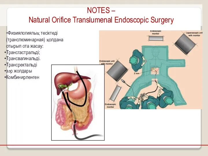 NOTES – Natural Orifice Translumenal Endoscopic Surgery -Физиялогиялық тесіктеді (транслюминарная) қолдана отырып