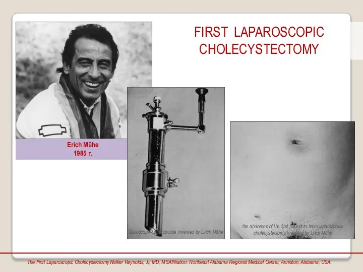 Erich Mühe 1985 г. FIRST LAPAROSCOPIC CHOLECYSTECTOMY The First Laparoscopic CholecystectomyWalker Reynolds,