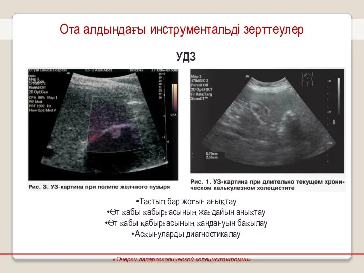 Ота алдындағы инструментальді зерттеулер УДЗ Тастың бар жоғын анықтау Өт қабы қабырғасының