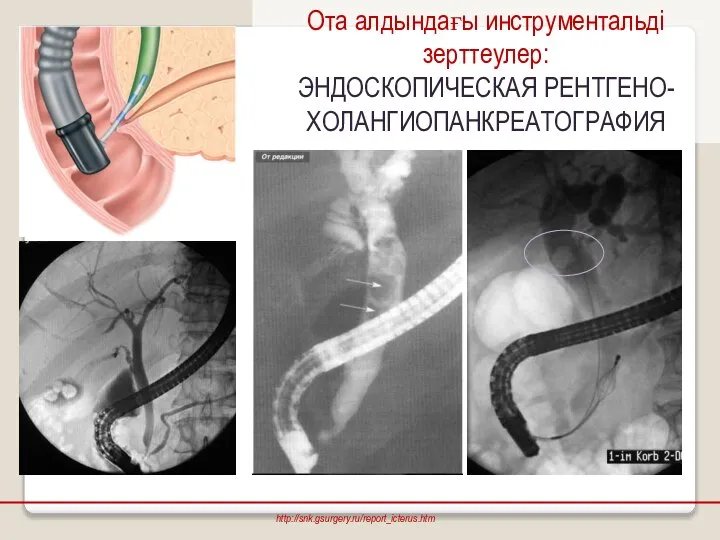 Ота алдындағы инструментальді зерттеулер: ЭНДОСКОПИЧЕСКАЯ РЕНТГЕНО- ХОЛАНГИОПАНКРЕАТОГРАФИЯ http://snk.gsurgery.ru/report_icterus.htm