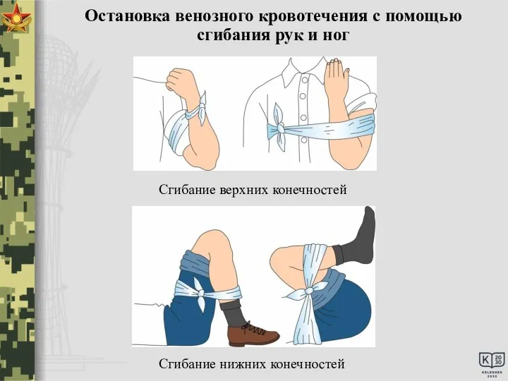 Остановка венозного кровотечения с помощью сгибания рук и ног Сгибание верхних конечностей Сгибание нижних конечностей